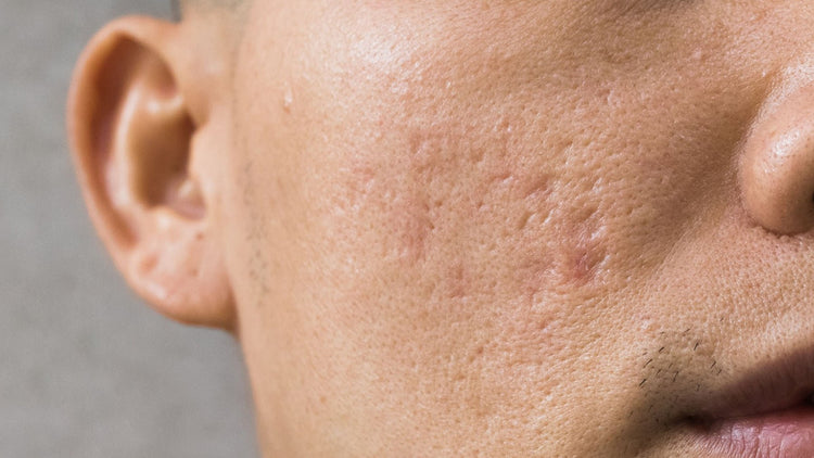 Skar İzlerine Medikal ve Dermokozmetik Çözümler - ya da multicosmetics